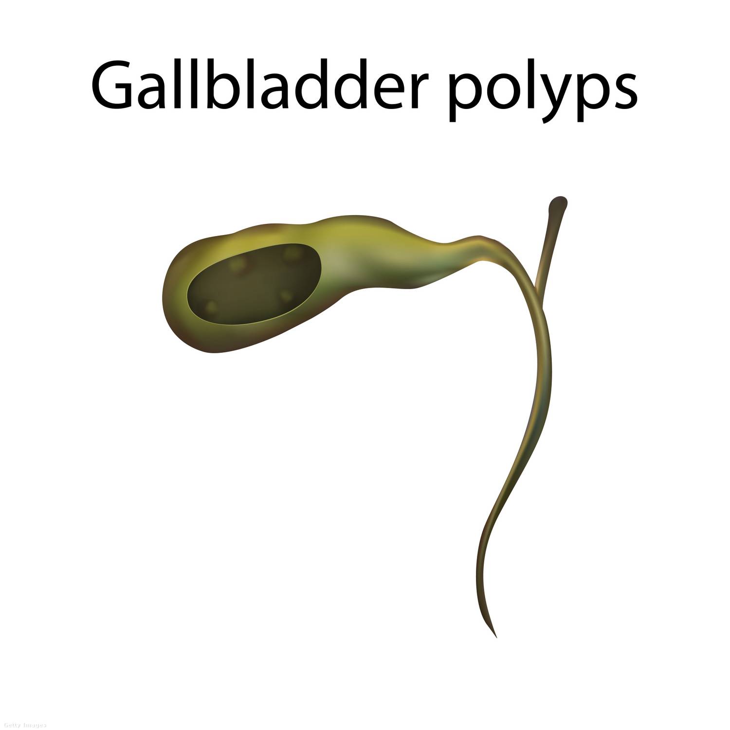 Epehólyag polip tünetei 1