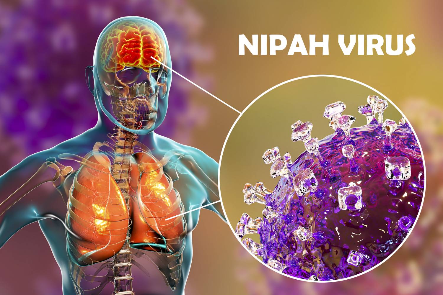 Nipah vírus helyzete 2026-ban 1