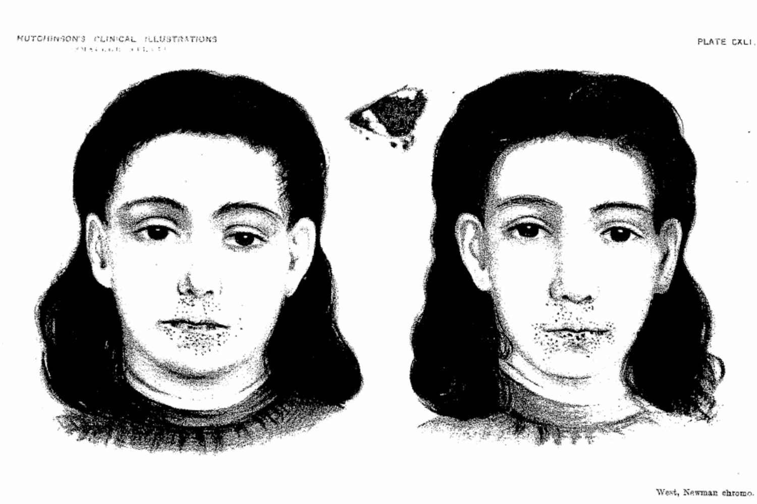 peutz&amp;amp;amp;amp;amp;amp;ndash;jeghers syndrome.png