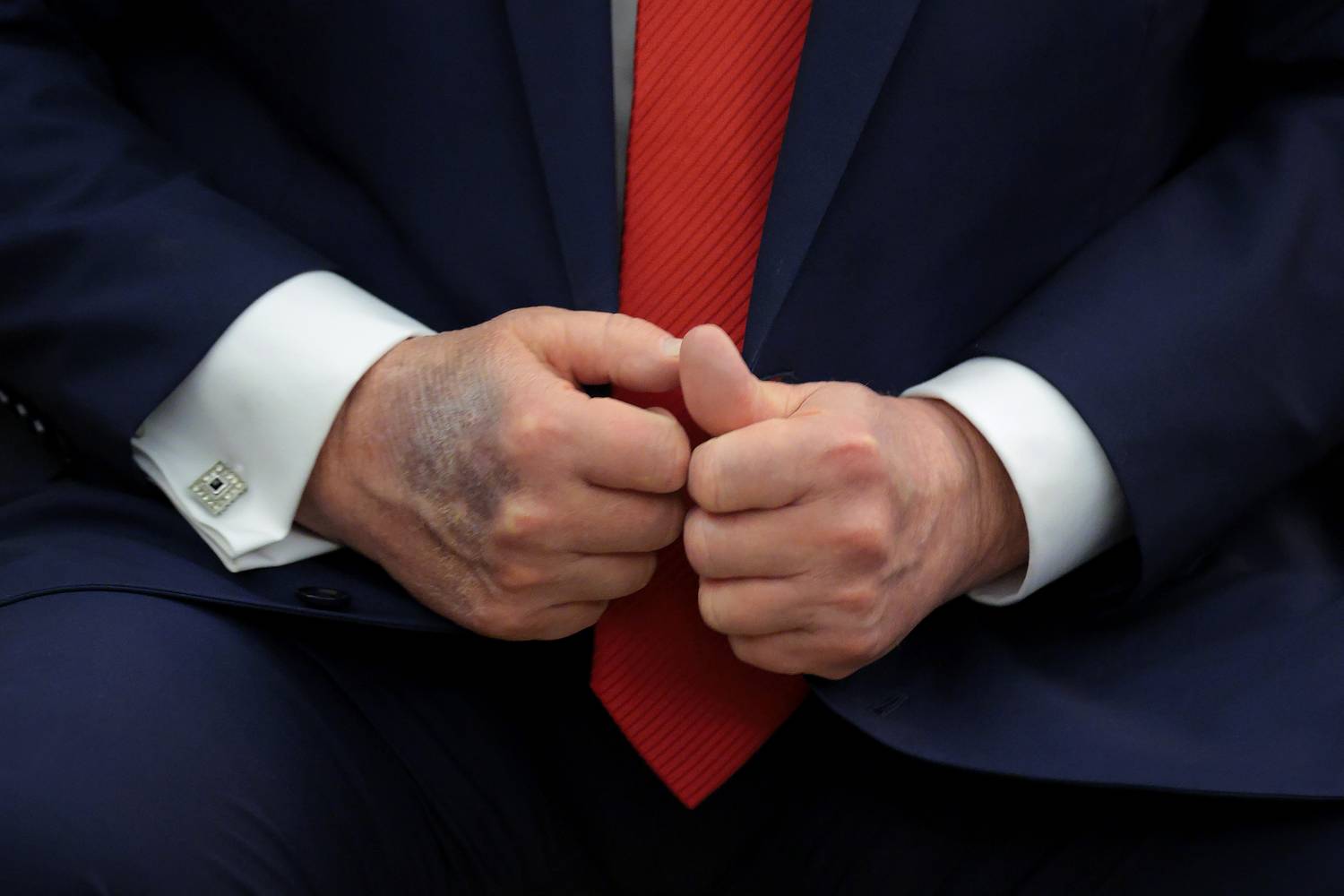 A szakértő szerint a Donald Trump kezein lévő zúzódás nem a sok kézfogástól van.