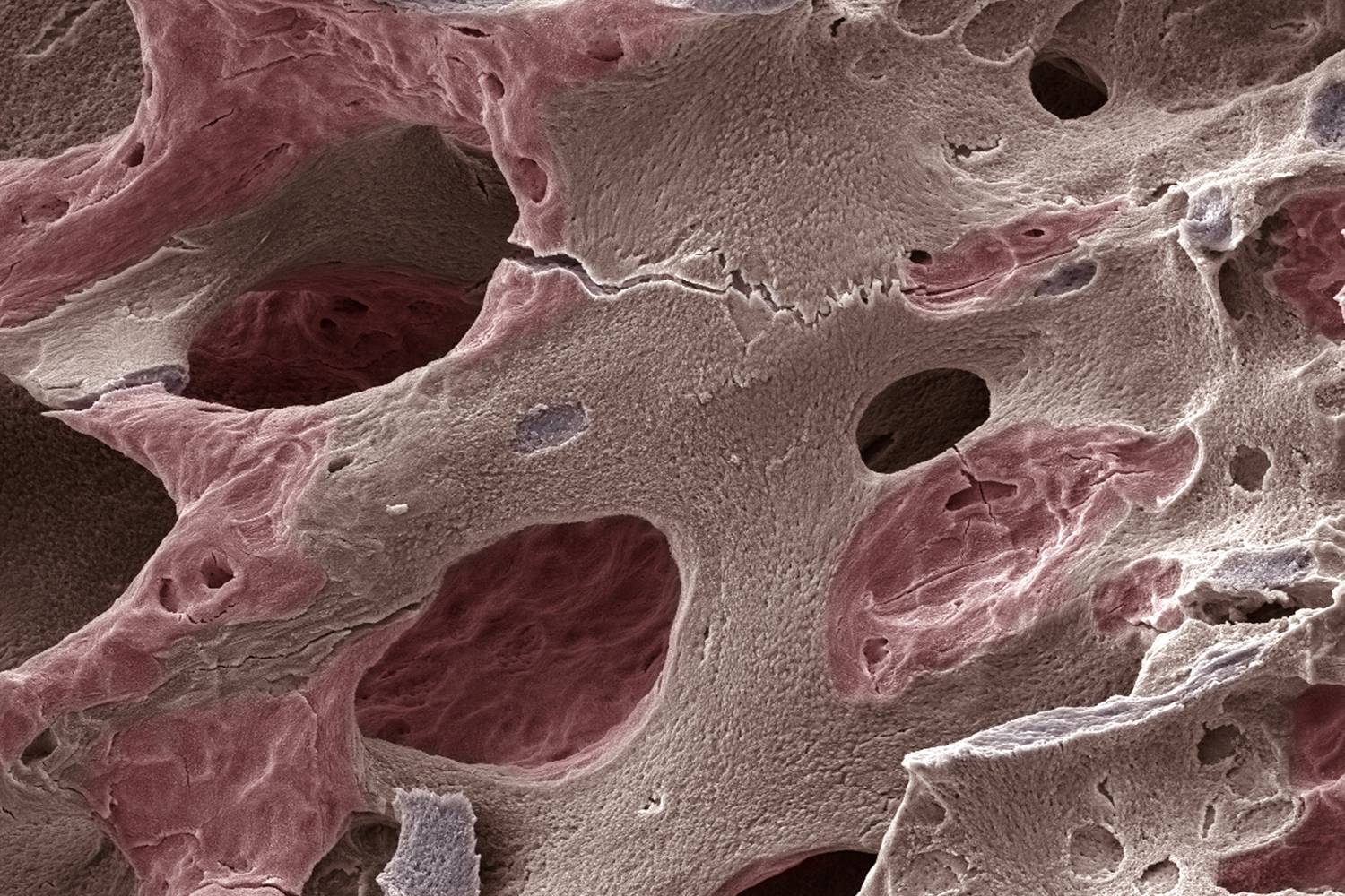 csontritkulas