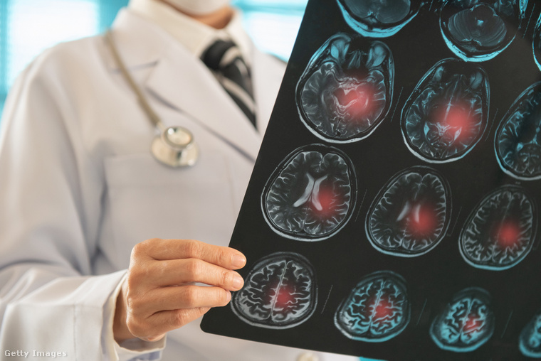 Egy apró rosszullét, beszédzavar vagy egy kis szédülés is jelezhetik a komolyabb bajt, ezért nem szabad legyinteni rájuk. (Illusztráció: Getty Images)