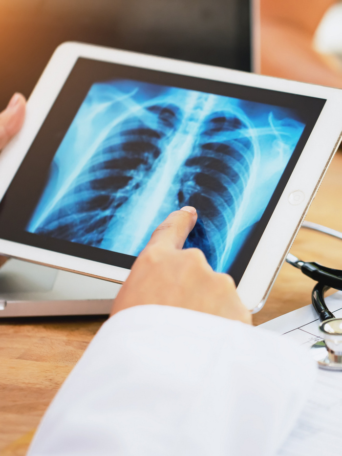 Miért alakulhat ki tüdőrák nem dohányzó fiataloknál? Meglepő választ találtak a kutatók