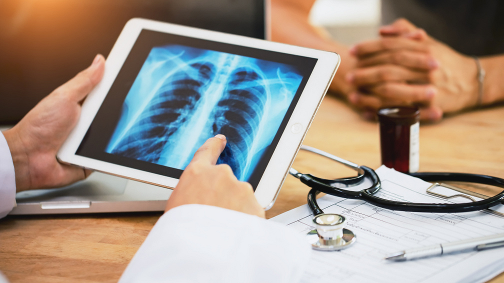 Miért alakulhat ki tüdőrák nem dohányzó fiataloknál? Meglepő választ találtak a kutatók