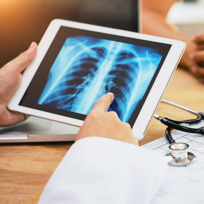 Miért alakulhat ki tüdőrák nem dohányzó fiataloknál? Meglepő választ találtak a kutatók