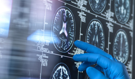 Ez a tünet előre jelezheti az Alzheimer-kórt