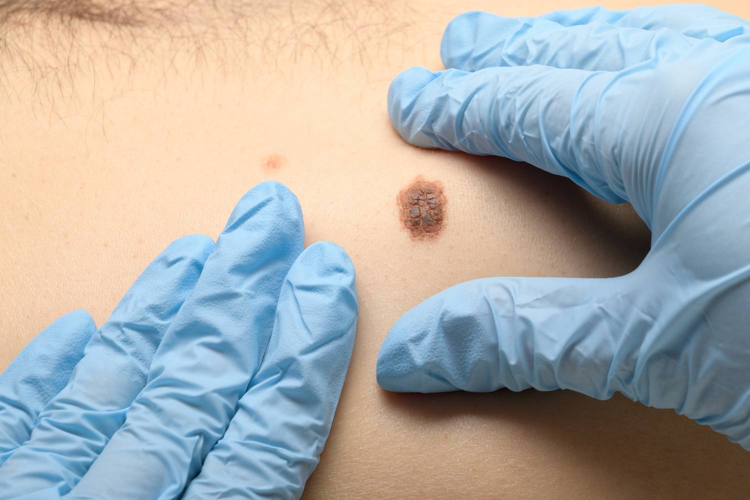melanoma (3)