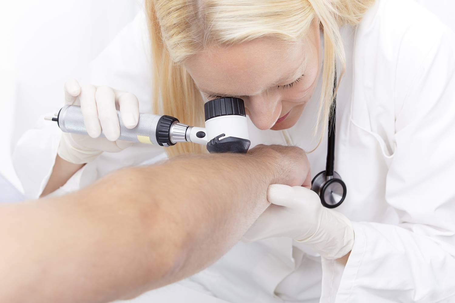 melanoma