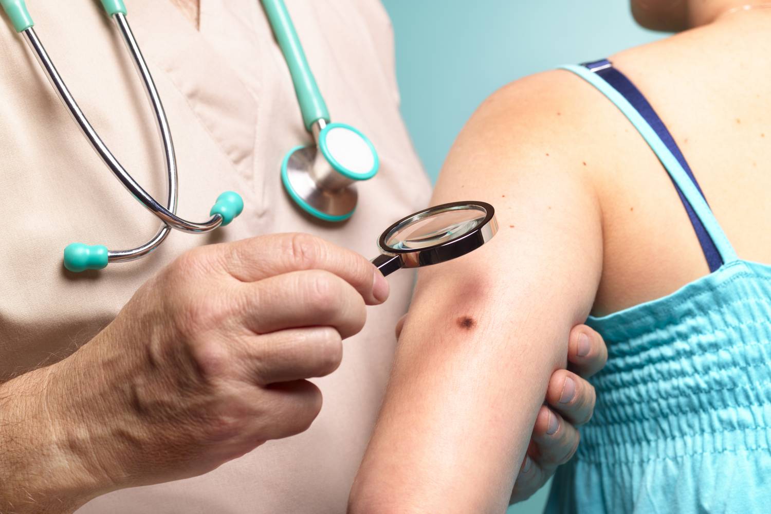 melanoma (2)