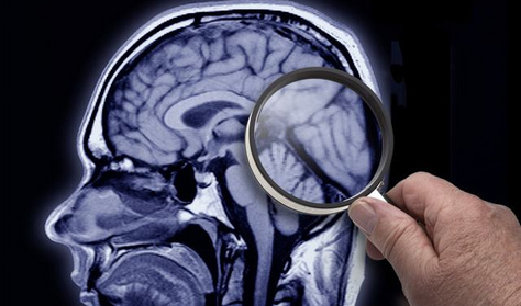 Kisebb lesz az esélyed az Alzheimer-kórra, ha ezt eszed