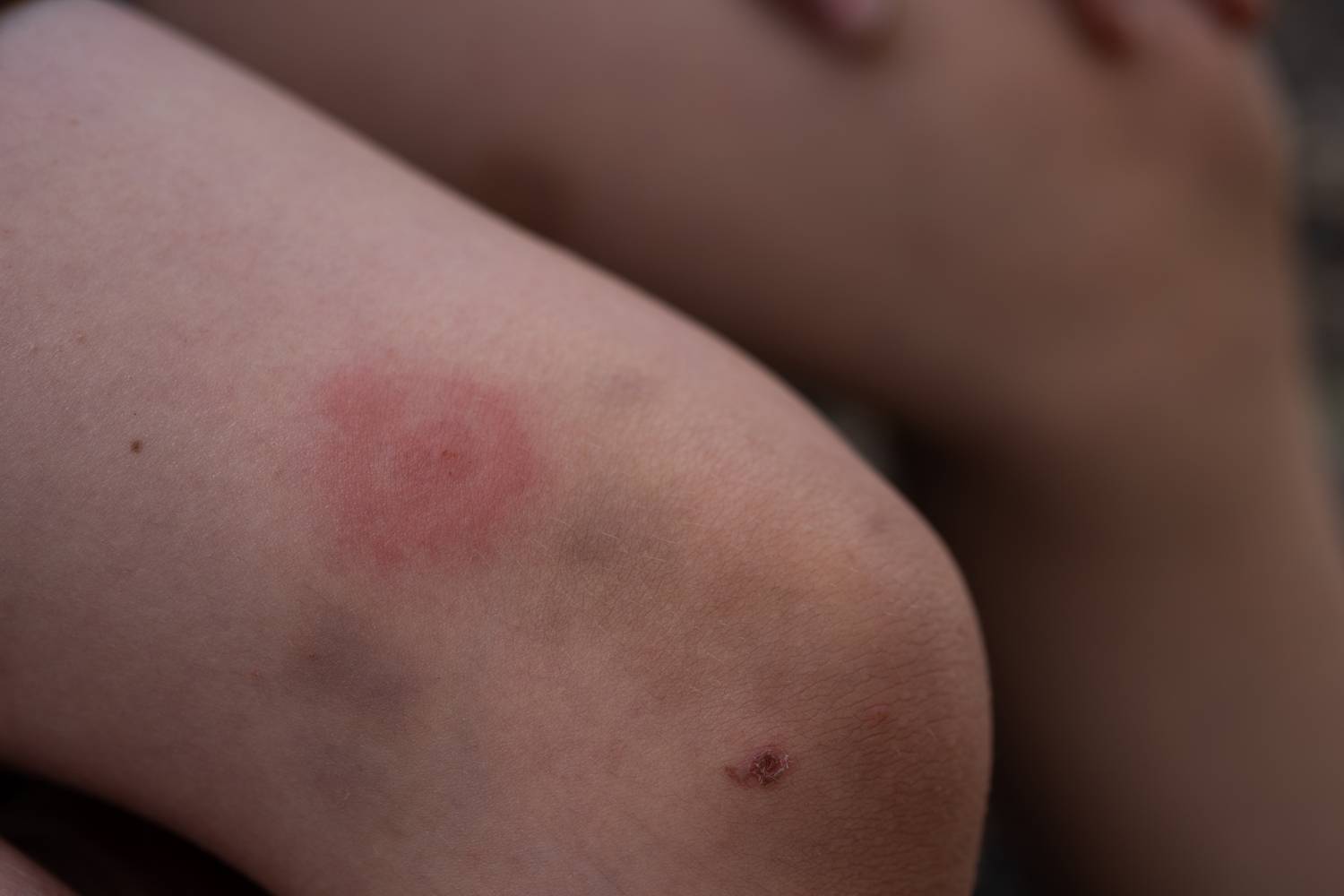 Lyme-kór tünetei és kezelése