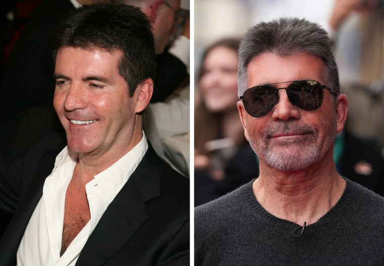 Simon Cowell&nbsp;Simon Cowell talán az egyik legőszintébb férfi híresség legalábbis a kozmetikai beavatkozásai kapcsán nem titkolózik különösebben