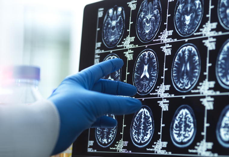 Az Alzheimer-kórnál más összefüggéseket találtakA szakértők az Alzheimer-kórra jellemző amiloid-béta és tau fehérjék felhalmozódását követték, a vizsgálat során pedig azt találták, hogy a cukorbetegség az amiloid-béta gyorsabb felhalmozódásával mutat kapcsolatot, míg az alacsonyabb testtömegindex mellett gyorsabb tau-felhalmozódást figyeltek meg