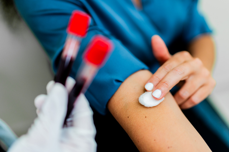 A ferritin nem csupán a vasraktárakról mesélA ferritinre leginkább úgy szokás gondolni, mint a szervezet vasraktárainak egyik fontos jelzőjére, de valójában a gyulladásokat is jelezheti