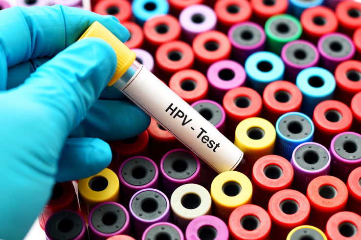 A HPV-teszt már a rák kialakulása előtt jelezhet